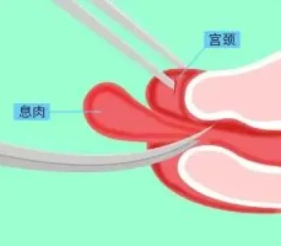 别被十几万全包价带偏，深圳私立三代试管六项费用一定问清