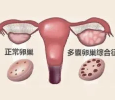 三代试管低价套餐藏着哪些费用？别把总价当成成功率
