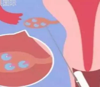 试管婴儿别被高成功率带节奏，花钱越多不等于成功率越高