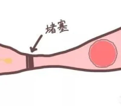 补佳乐吃到乳房胀痛就代表着床了吗？别把药物反应当成好孕信号