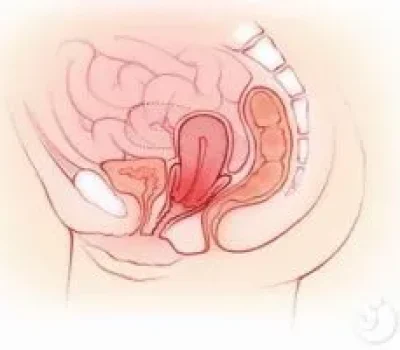 试管移植失败别急着查全套，胚胎外观和内膜厚度都不是唯一答案