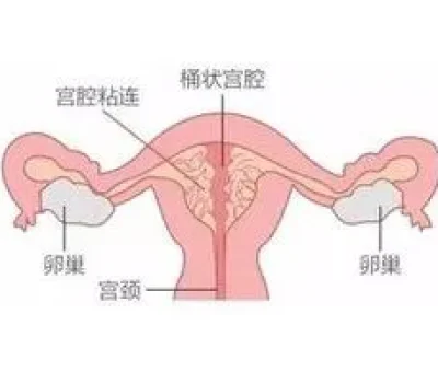 二胎不是再来一回，剖宫产瘢痕身体状况和家庭分工都要先评估